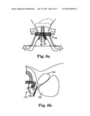 MALE URETHRAL PROSTHESIS WITH TENSIONING MEMBER diagram and image