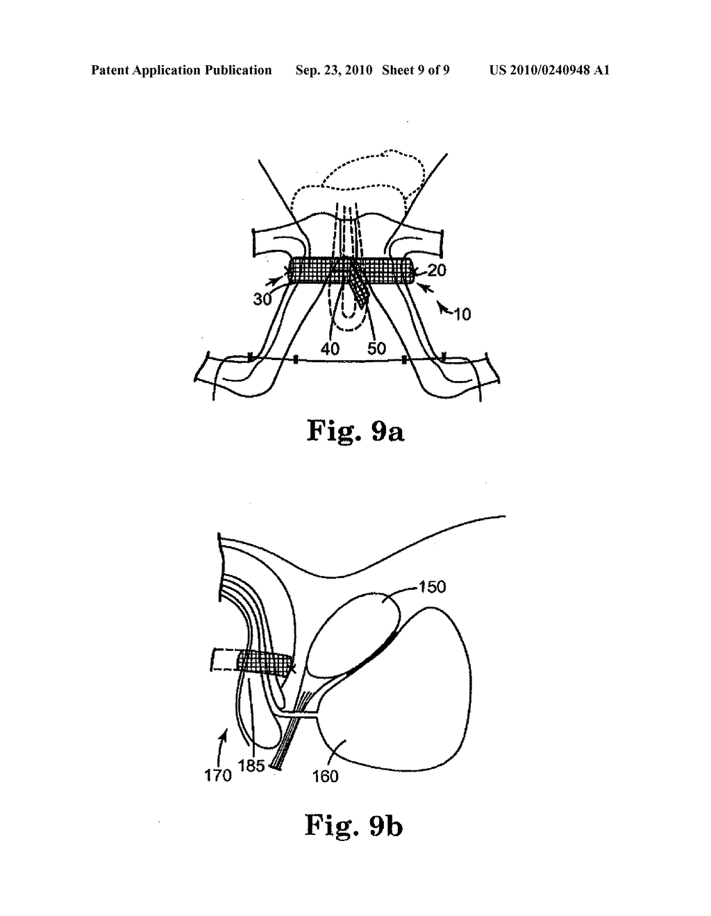 MALE URETHRAL PROSTHESIS WITH TENSIONING MEMBER - diagram, schematic, and image 10