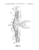 OSTOMY APPLIANCE diagram and image