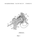 Tissue Cavitation Device and Method diagram and image