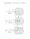 Tissue Cavitation Device and Method diagram and image