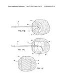 Tissue Cavitation Device and Method diagram and image