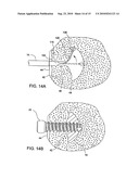 Tissue Cavitation Device and Method diagram and image