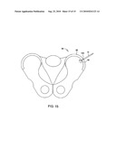 Tissue Cavitation Device and Method diagram and image