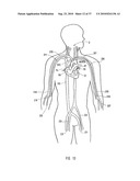 METHODS, SYSTEMS, AND DEVICES FOR DEPLOYING AN EMBOLIC PROTECTION FILTER diagram and image