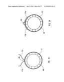 METHODS, SYSTEMS, AND DEVICES FOR DEPLOYING AN EMBOLIC PROTECTION FILTER diagram and image