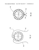 METHODS, SYSTEMS, AND DEVICES FOR DEPLOYING AN EMBOLIC PROTECTION FILTER diagram and image