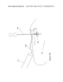 INFLATABLE MEDICAL DEVICES diagram and image