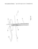 INFLATABLE MEDICAL DEVICES diagram and image