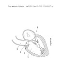 INFLATABLE MEDICAL DEVICES diagram and image