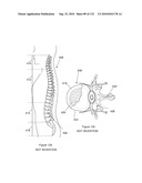 INFLATABLE MEDICAL DEVICES diagram and image