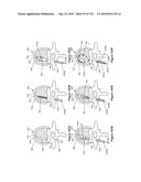 INFLATABLE MEDICAL DEVICES diagram and image