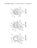 INFLATABLE MEDICAL DEVICES diagram and image