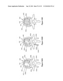 INFLATABLE MEDICAL DEVICES diagram and image