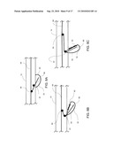 STEERABLE EPICARDIAL PACING CATHETER SYSTEM PLACED VIA THE SUBXIPHOID PROCESS diagram and image