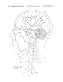 INDWELLING HEAT EXCHANGE CATHETER AND METHOD OF USING SAME diagram and image