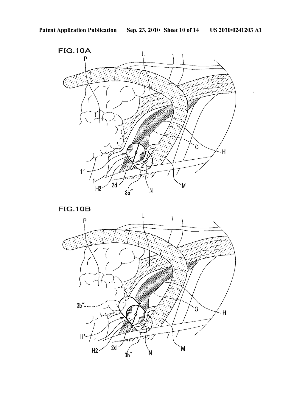 ELECTRODE FOR CONTINUOUSLY STIMULATING FACIAL NERVE ROOT AND APPARATUS FOR MONITORING ELECTROMYOGRAMS OF FACIAL MUSCLES USING THE ELECTRODE THEREOF - diagram, schematic, and image 11