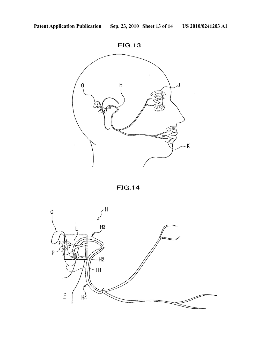 ELECTRODE FOR CONTINUOUSLY STIMULATING FACIAL NERVE ROOT AND APPARATUS FOR MONITORING ELECTROMYOGRAMS OF FACIAL MUSCLES USING THE ELECTRODE THEREOF - diagram, schematic, and image 14
