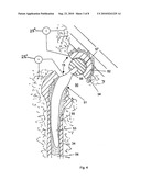 MEDICAL IMPLANT diagram and image