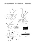 MEDICAL IMPLANT diagram and image