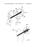 MEDICAL IMPLANT diagram and image