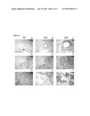 COMPOSITIONS AND METHODS FOR DIAGNOSIS AND TREATMENT OF CANCER diagram and image