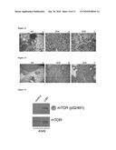 COMPOSITIONS AND METHODS FOR DIAGNOSIS AND TREATMENT OF CANCER diagram and image