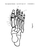 TOE BRACE DESIGNS diagram and image