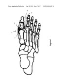 TOE BRACE DESIGNS diagram and image