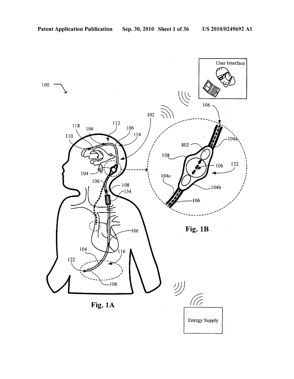 Systems, devices, and methods including infection-Fighting and monitoring shunts - diagram, schematic, and image 02