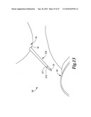 SURGICAL INSTRUMENTS FOR IN VIVO ASSEMBLY diagram and image