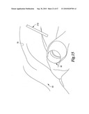 SURGICAL INSTRUMENTS FOR IN VIVO ASSEMBLY diagram and image