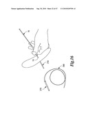 SURGICAL INSTRUMENTS FOR IN VIVO ASSEMBLY diagram and image