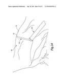 SURGICAL INSTRUMENTS FOR IN VIVO ASSEMBLY diagram and image