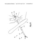 SURGICAL INSTRUMENTS FOR IN VIVO ASSEMBLY diagram and image