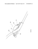 DEFORMABLE MEDICAL IMPLANT diagram and image