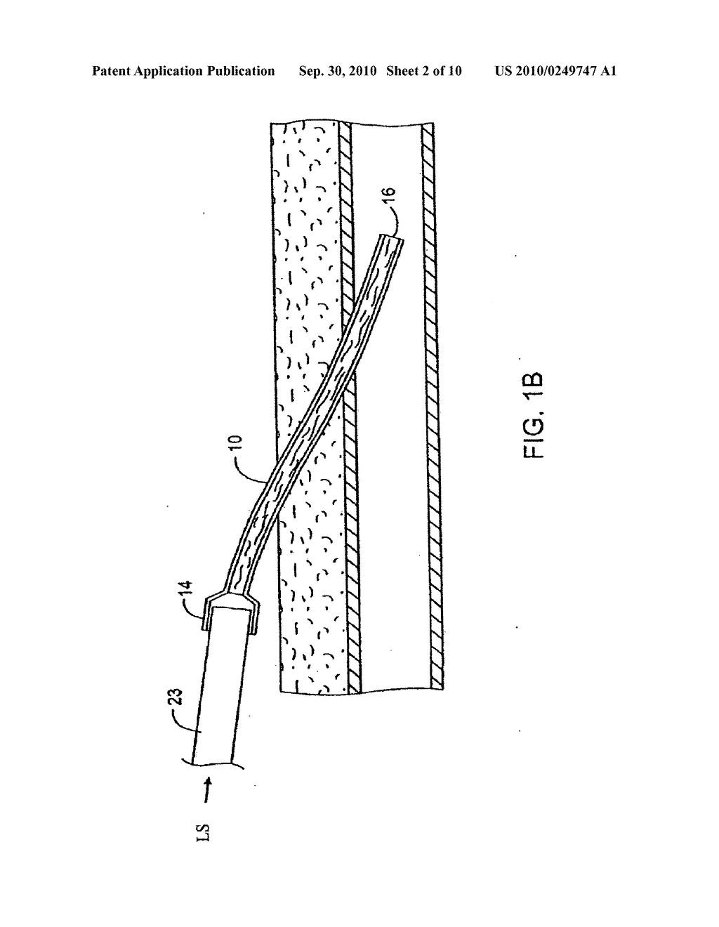 Transdermal venous access locking solution - diagram, schematic, and image 03