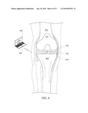 SYSTEM AND METHOD FOR ORTHOPEDIC DYNAMIC DISTRACTION diagram and image