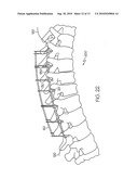 APPARATUS FOR MINIMALLY INVASIVE POSTERIOR CORRECTION OF SPINAL DEFORMITY diagram and image