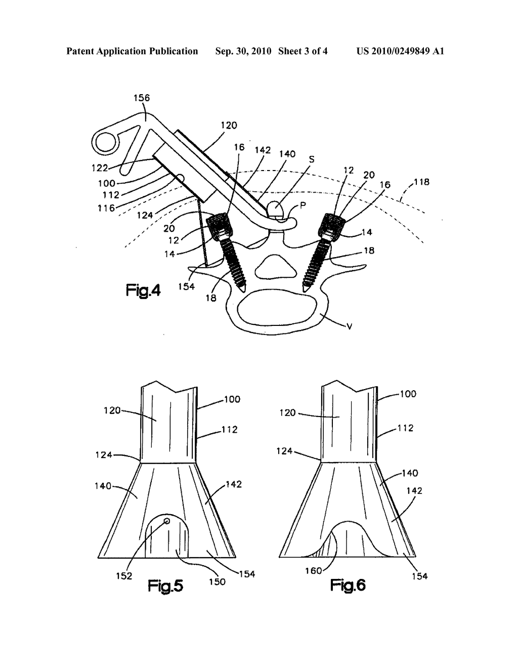 METHOD FOR INTERCONNECTING LONGITUDINAL MEMBERS EXTENDING ALONG A SPINAL COLUMN - diagram, schematic, and image 04