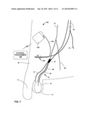 ELECTRICAL STIMULATION OF ILIOHYPOGASTRIC NERVE TO ALLEVIATE CHRONIC PELVIC PAIN diagram and image