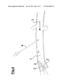 DEVICE FOR IMPLANTING A VASCULAR PROSTHESIS diagram and image