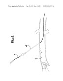 DEVICE FOR IMPLANTING A VASCULAR PROSTHESIS diagram and image