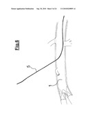 DEVICE FOR IMPLANTING A VASCULAR PROSTHESIS diagram and image