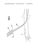 DEVICE FOR IMPLANTING A VASCULAR PROSTHESIS diagram and image