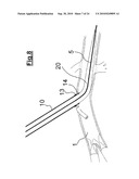 DEVICE FOR IMPLANTING A VASCULAR PROSTHESIS diagram and image