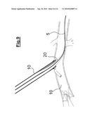 DEVICE FOR IMPLANTING A VASCULAR PROSTHESIS diagram and image