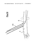 DEVICE FOR IMPLANTING A VASCULAR PROSTHESIS diagram and image