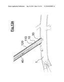 DEVICE FOR IMPLANTING A VASCULAR PROSTHESIS diagram and image