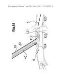 DEVICE FOR IMPLANTING A VASCULAR PROSTHESIS diagram and image